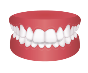 上顎前突(出っ歯) {{brizy_dc_image_alt imageSrc=