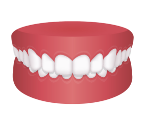 過蓋咬合 {{brizy_dc_image_alt imageSrc=