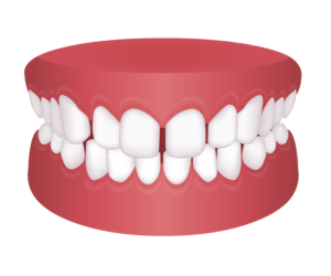 空隙歯列 {{brizy_dc_image_alt imageSrc=