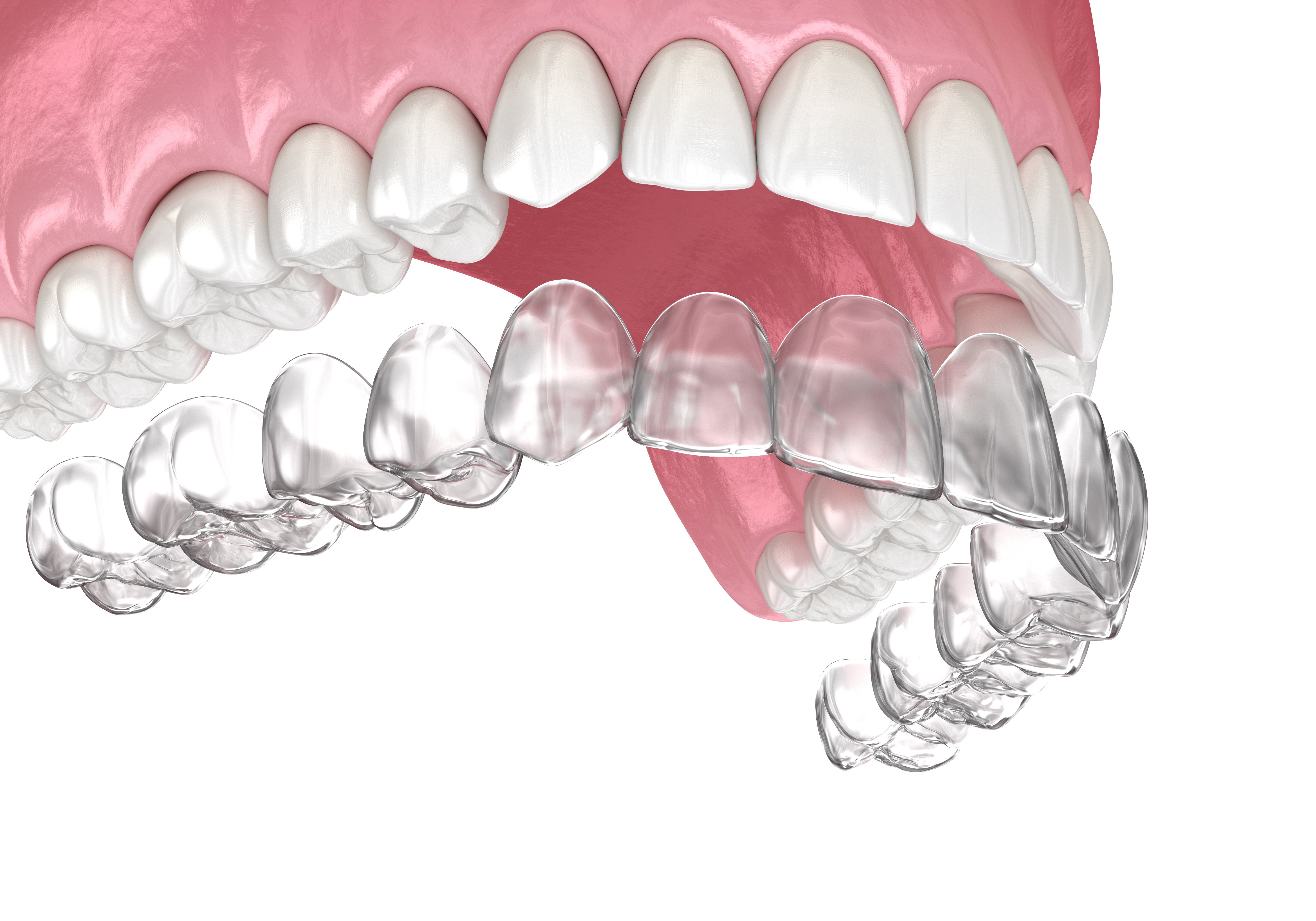 マウスピース矯正